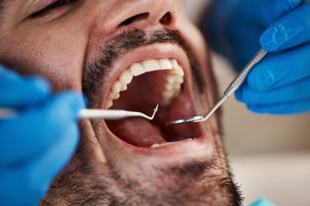 Teeth Whitening in UT